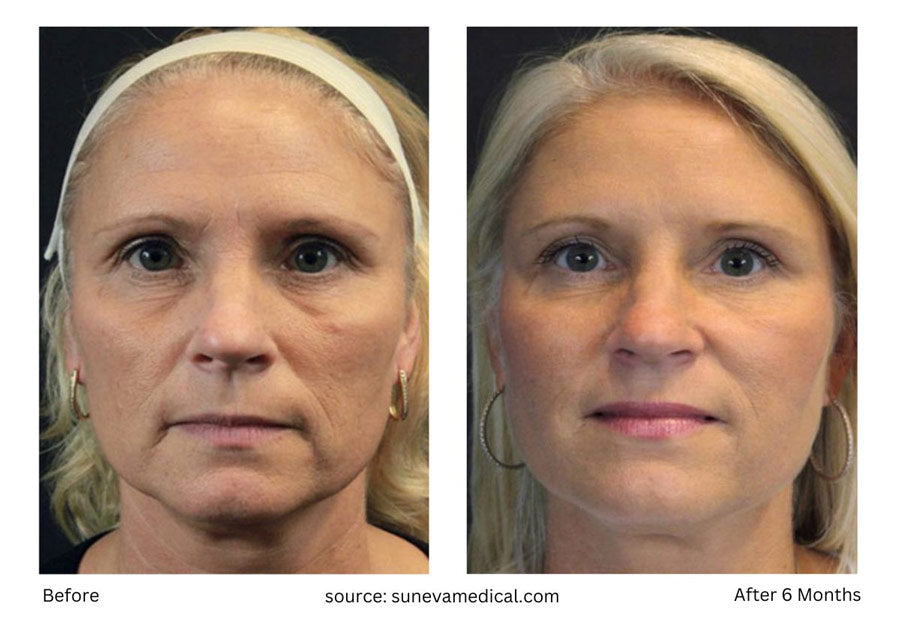 Benefits of Silhouette InstaLift