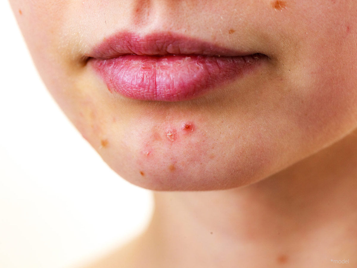 Acne Treatment