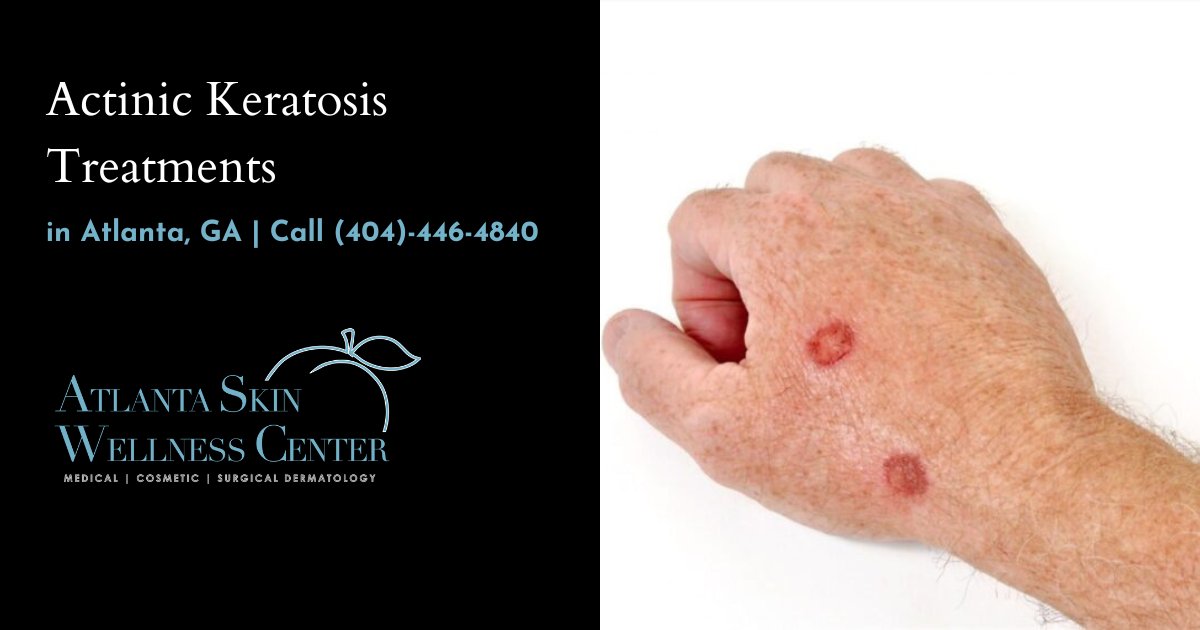 Actinic Keratosis Treatment Atlanta Skin Wellness Center actinic-keratosis-treatment-atlanta-skin-wellness-center