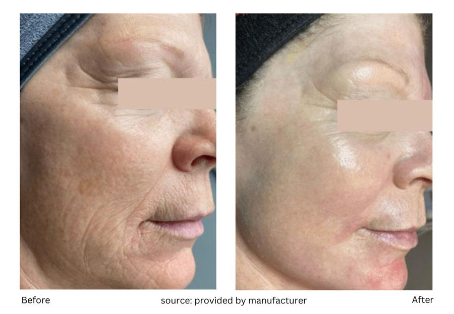 Applications of the Tetra CO2 laser