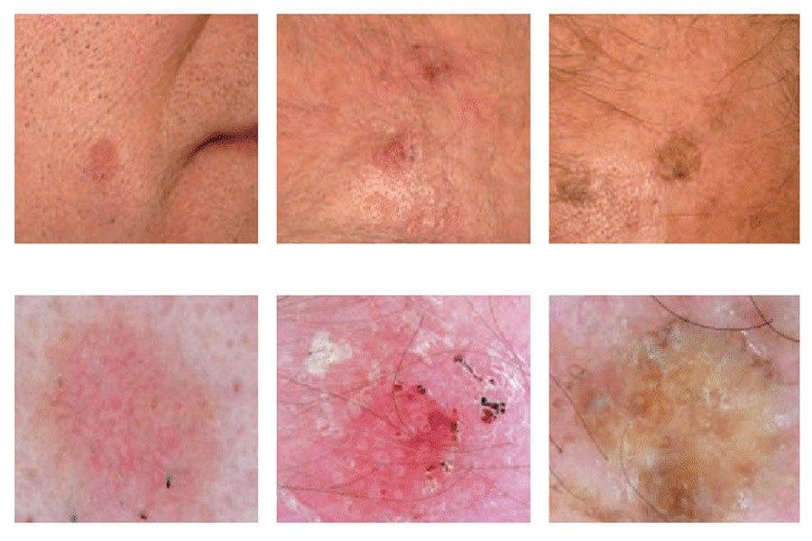 Actinic Keratosis