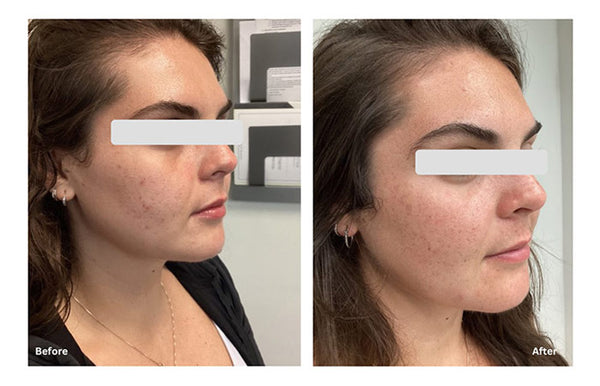 EVO 1064 Laser treatment for Redness and Scars