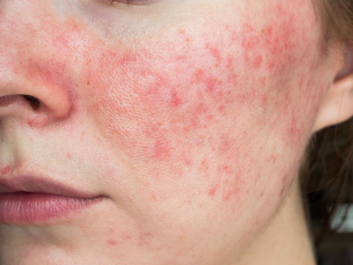 glutathione rosacea Rosacea Treatment in Atlanta, GA