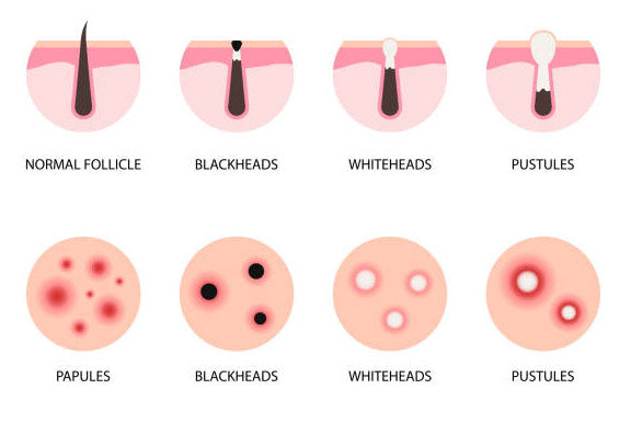 Acne Types