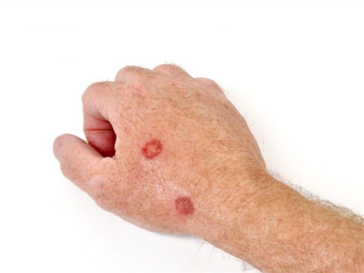 Actinic Keratosis