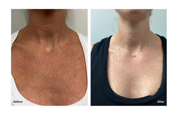 CoolPeel Laser on Chest