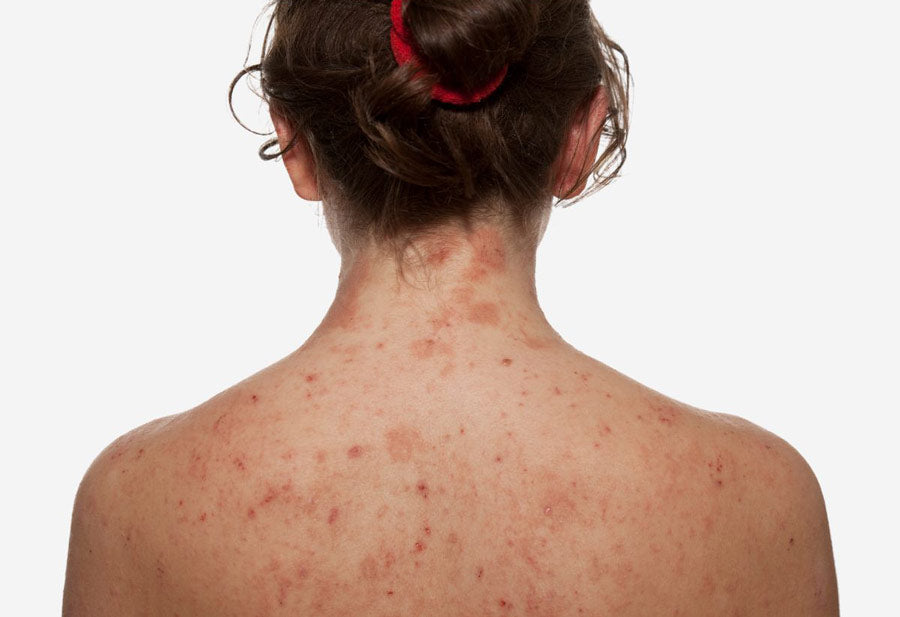 What Causes Eczema? 