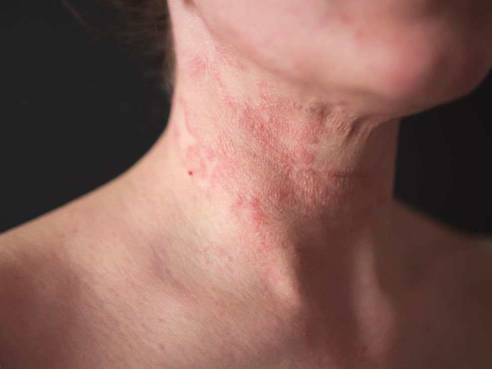 Eczema