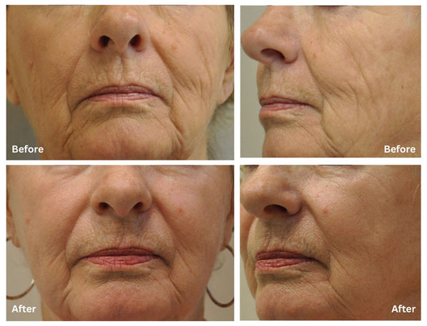 Fractional Laser Treatment - Face