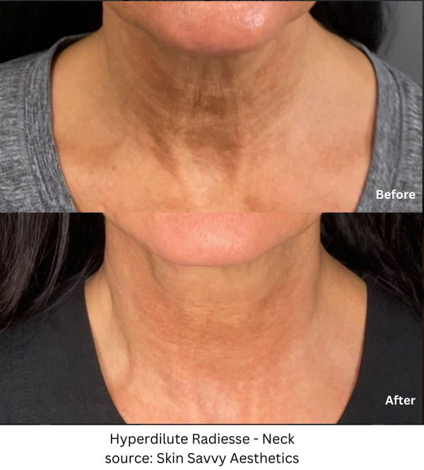 Hyperdilute Radiesse - Neck