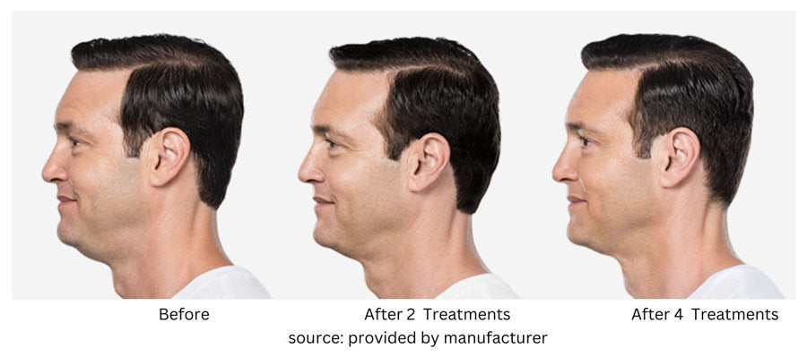 Benefits of KYBELLA® 