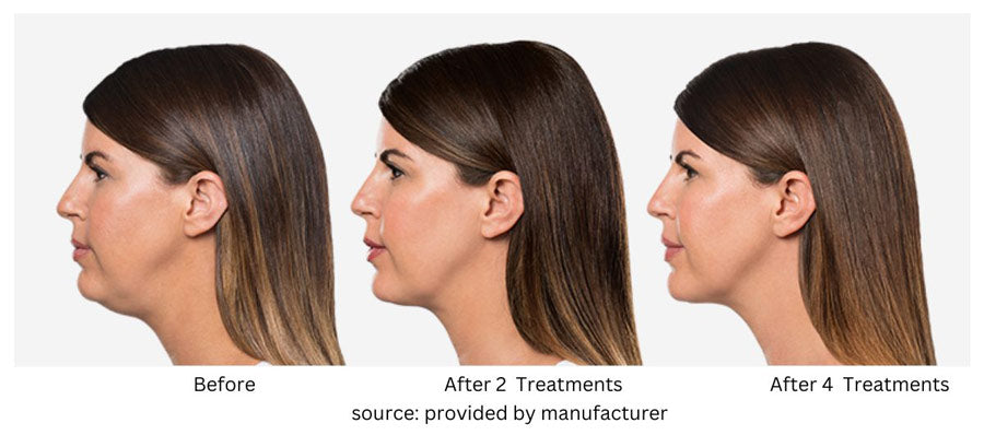 Is KYBELLA® the Right Choice for You? 