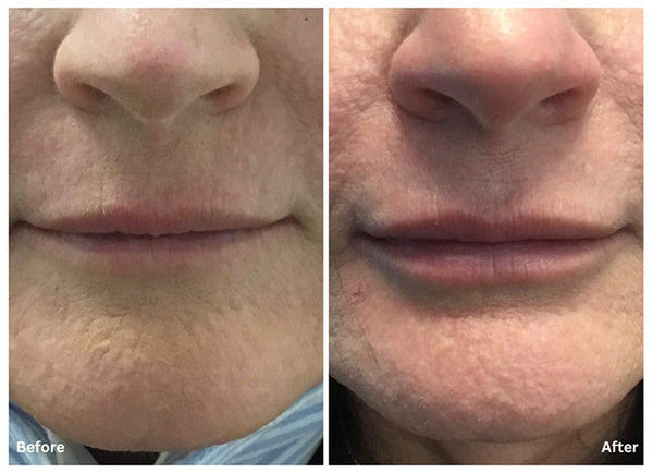 Lip Enhancement with Hyaluronic Acid Filler