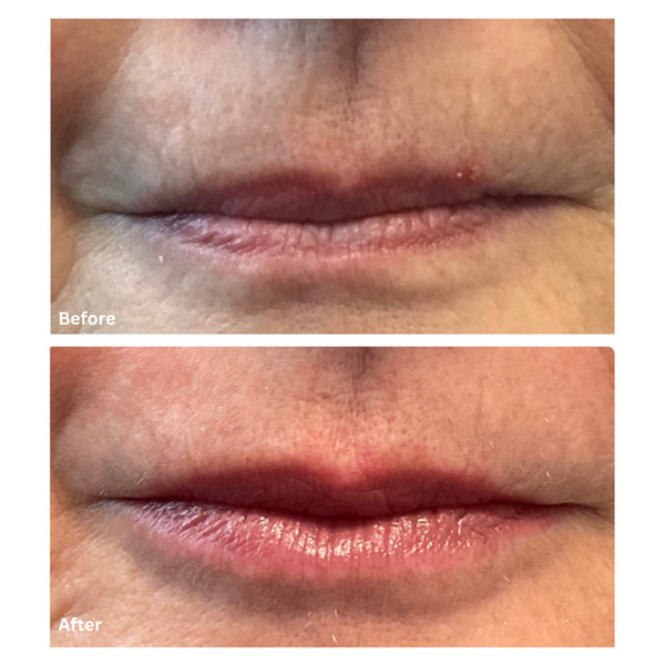 Lip Enhancement with Hyaluronic Acid Filler