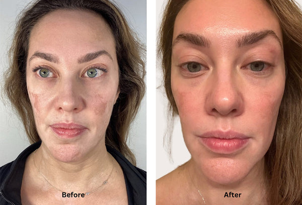 Melasma treatment with Chemical Peels, Coolpeel laser treatment