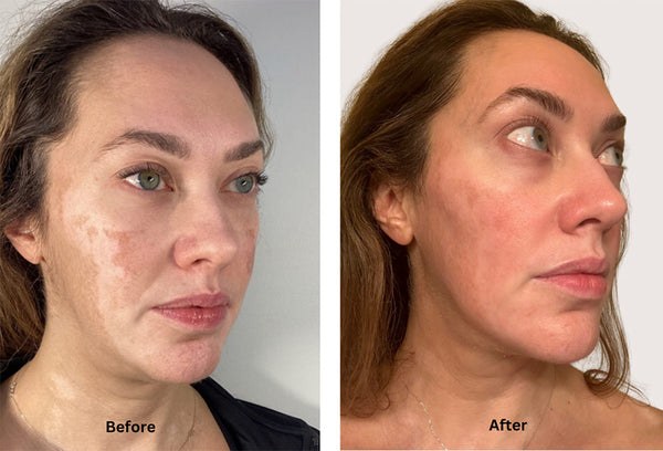 Melasma treatment with Chemical Peels, Coolpeel laser treatment