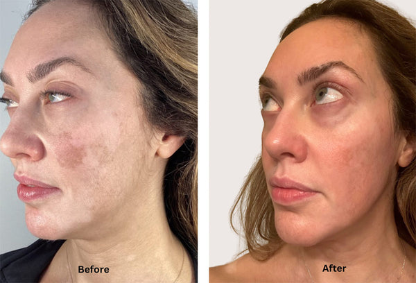 Melasma treatment with Chemical Peels, Coolpeel laser treatment