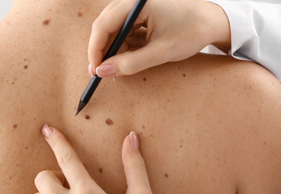 Knowing When to Consult a Doctor About Your Mole 