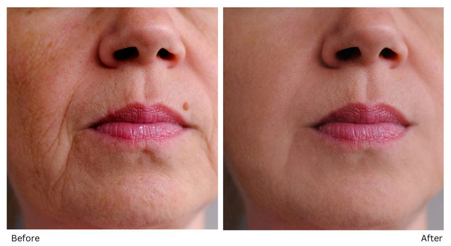 Why Book Mole Removal at Atlanta Skin Wellness Center? 