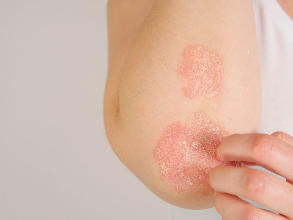 Psoriasis Treatment