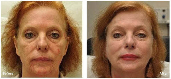 Sculptra Treatment with 1 Syringe Restylane Filler in Lips