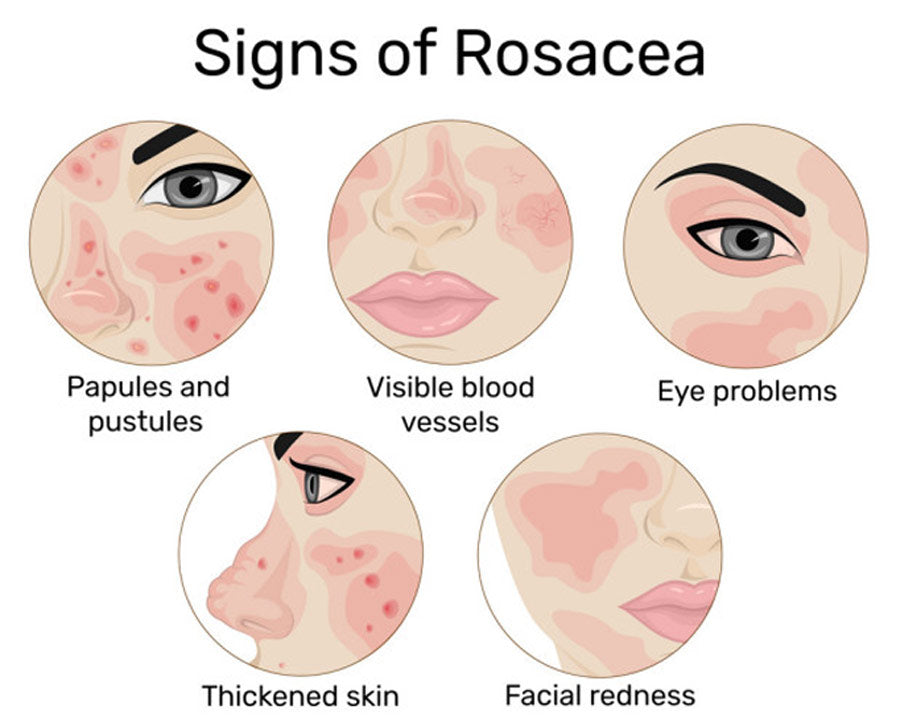 If You Have Rosacea, You're Not Alone 