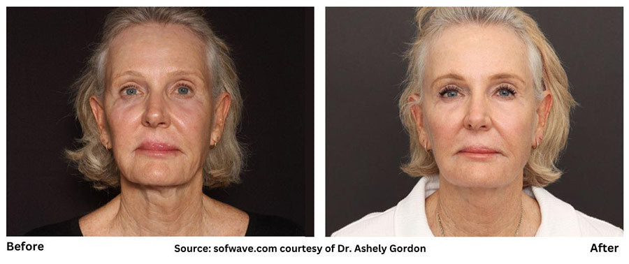 Sofwave for Wrinkles: Before and After 