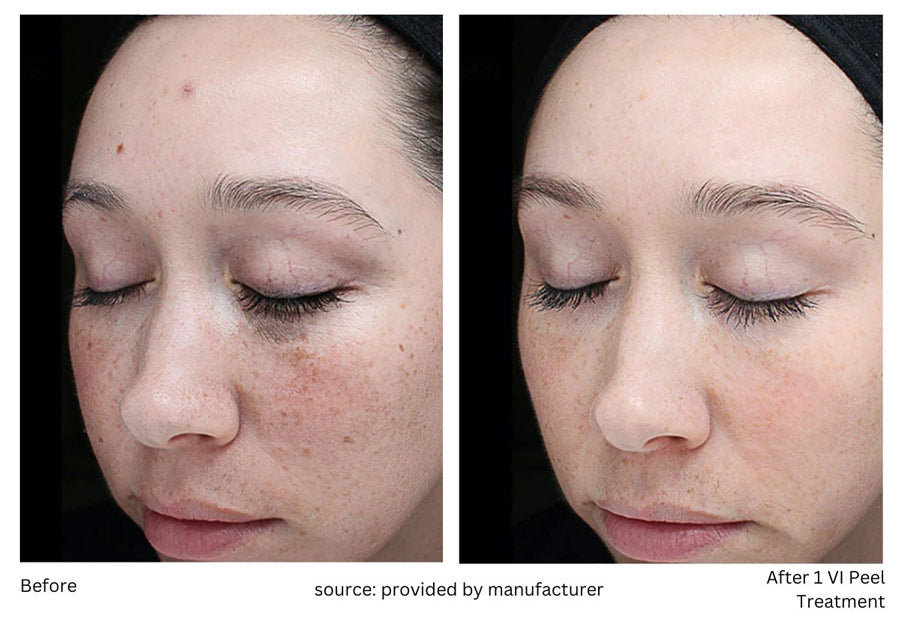 Discover the Power of Chemical Peels: