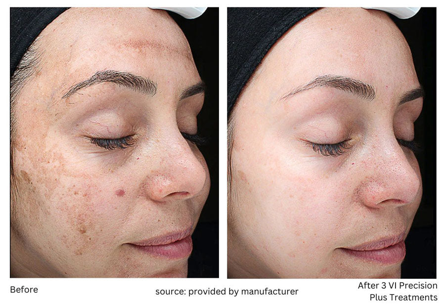 Our Chemical Peel Options: